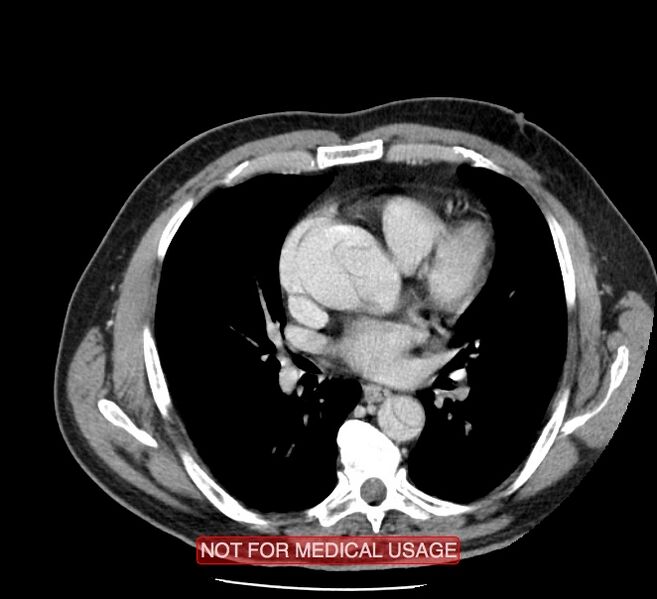 File:Acute aortic dissection - Stanford type A (Radiopaedia 40661-43285 Axial C+ portal venous phase 28).jpg