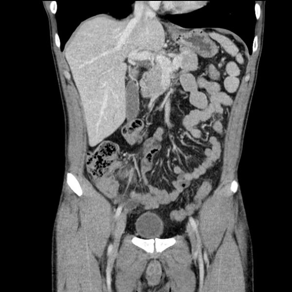 File:Acute appendicitis (Radiopaedia 27049-27227 Coronal C+ portal venous phase 20).jpg