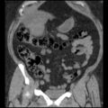 Acute cholecystitis and ureteric colic (Radiopaedia 42330-45444 Coronal prone 36).jpg
