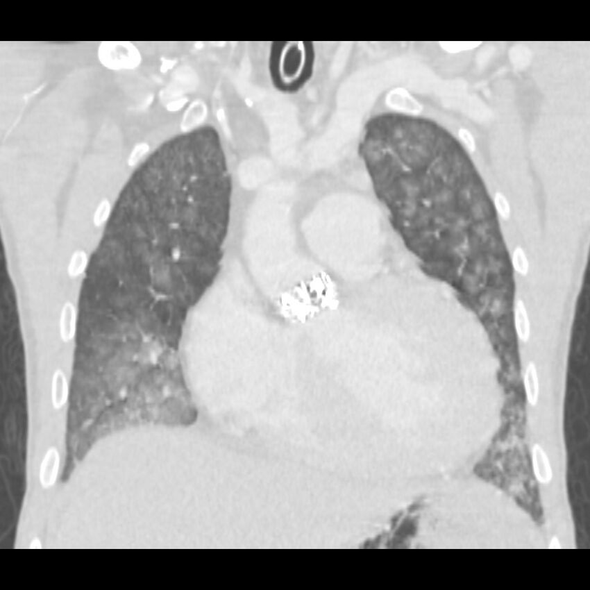 Acute diffuse alveolar hemorrhage (Radiopaedia 41323-44158 Coronal lung window 14).jpg