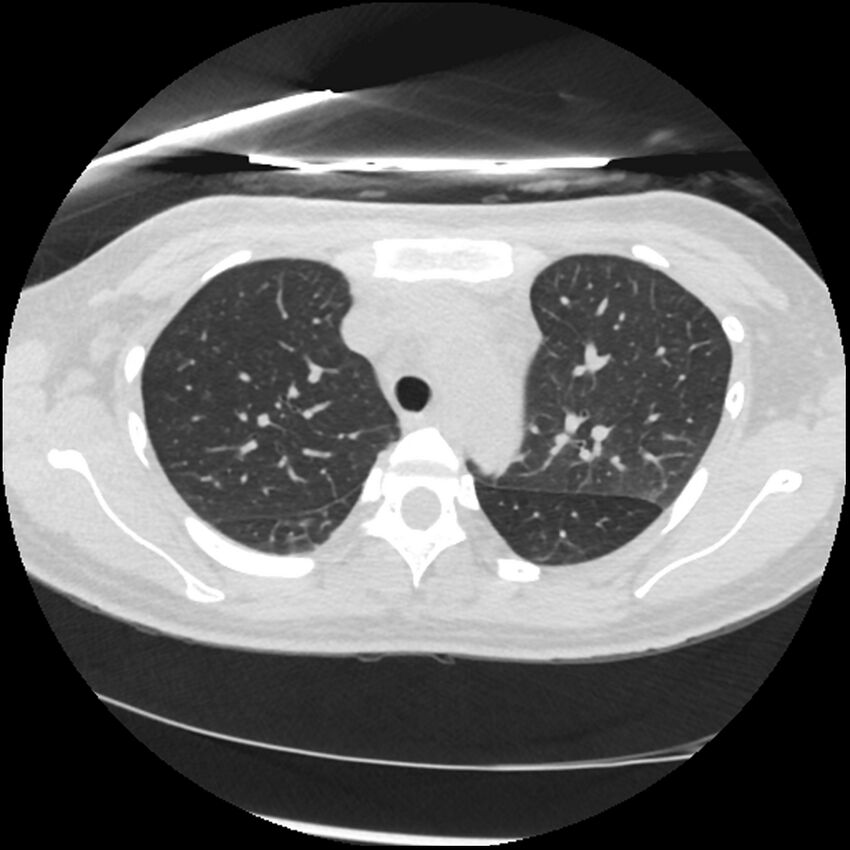 Acute lupus nephritis (Radiopaedia 45832-50107 Axial lung window 24).jpg
