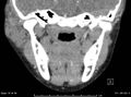 Acute parotitis (Radiopaedia 54123-60294 Coronal C+ arterial phase 4).jpg