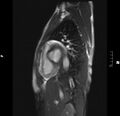 Acute perimyocarditis (Radiopaedia 48034-52833 Sagittal TRUFI CINE SHORT AXIS 67).JPG