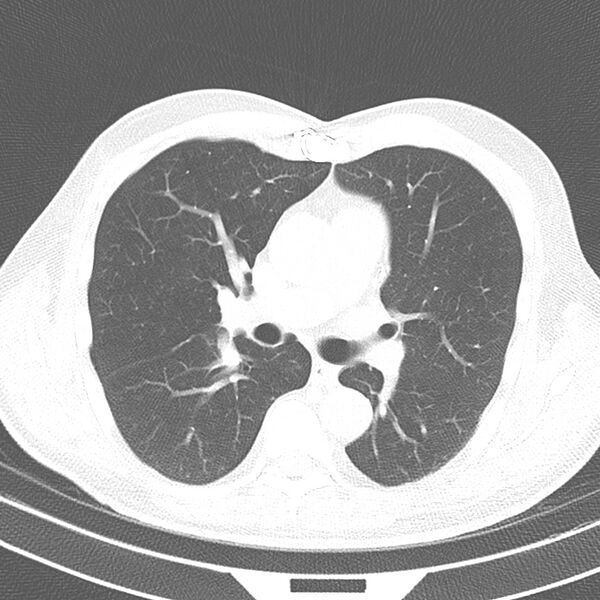 File:Acute pulmonary embolism (Radiopaedia 81677-95570 Axial lung window 21).jpg