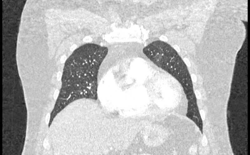 File:Acute pulmonary embolism with pulmonary infarcts (Radiopaedia 77688-89908 Coronal lung window 15).jpg