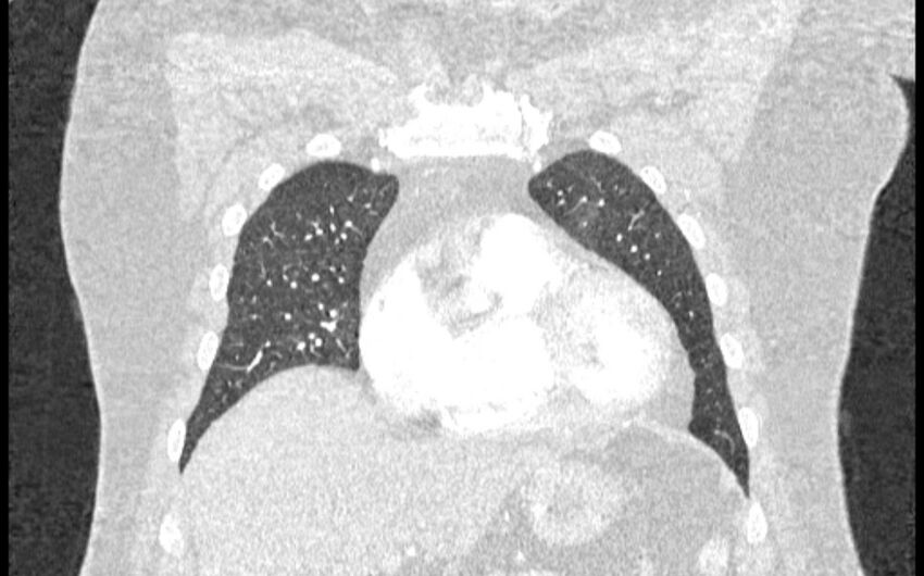 Acute pulmonary embolism with pulmonary infarcts (Radiopaedia 77688-89908 Coronal lung window 15).jpg