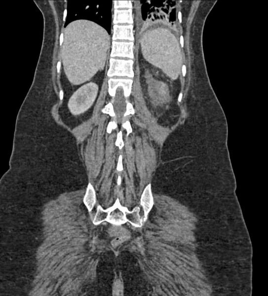 File:Acute pyelonephritis with renal vein thrombosis (Radiopaedia 58020-65053 Coronal renal parenchymal phase 106).jpg