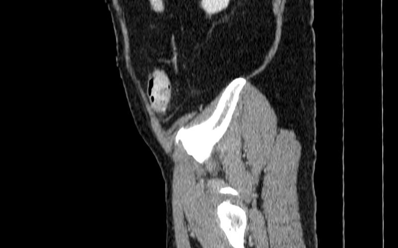 File:Acute sigmoid colon diverticulitis (Radiopaedia 55507-61976 Sagittal C+ portal venous phase 122).jpg