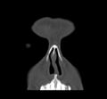 Acute sinusitis (Radiopaedia 23161-23215 Coronal bone window 17).jpg