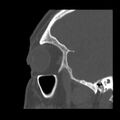 Acute sinusitis (Radiopaedia 23161-23215 Sagittal bone window 51).jpg