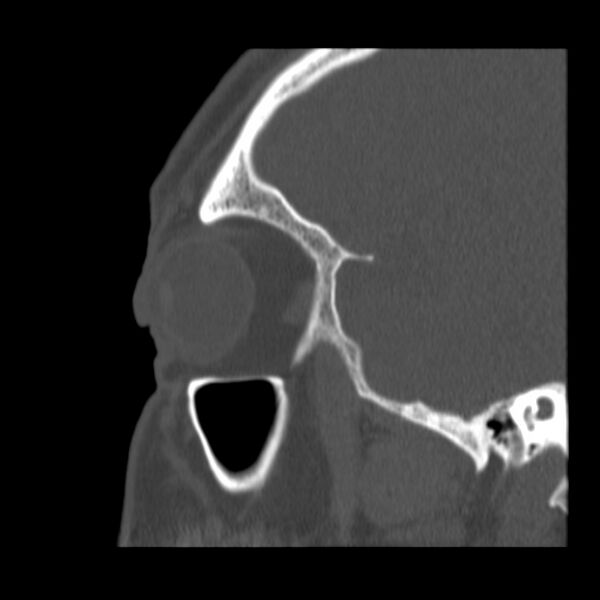 File:Acute sinusitis (Radiopaedia 23161-23215 Sagittal bone window 51).jpg