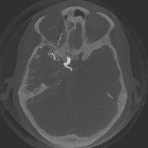 File:Acute subarachnoid hemorrhage and accessory anterior cerebral artery (Radiopaedia 69231-79010 Axial arterial - MIP 26).jpg