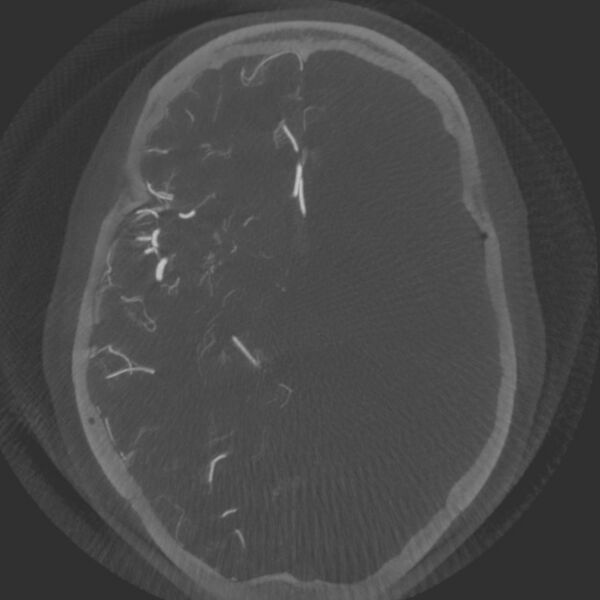 File:Acute subarachnoid hemorrhage and accessory anterior cerebral artery (Radiopaedia 69231-79010 Axial arterial - MIP 37).jpg