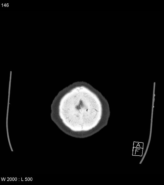 File:Acute subdural hematoma with myelofibrosis (Radiopaedia 52582-58494 Axial bone window 73).jpg