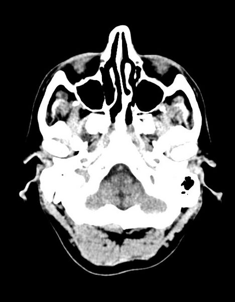File:Acute superior cerebellar artery territory infarct (Radiopaedia 84104-99359 Axial non-contrast 58).jpg