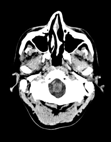 File:Acute superior cerebellar artery territory infarct (Radiopaedia 84104-99359 Axial non-contrast 60).jpg