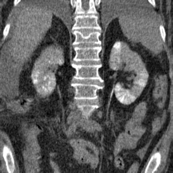 File:Acute tubular necrosis (Radiopaedia 28077-28334 Coronal non-contrast 13).jpg