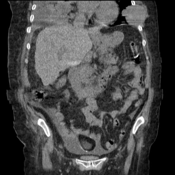 File:Acute tubular necrosis (Radiopaedia 28077-28334 G 40).jpg