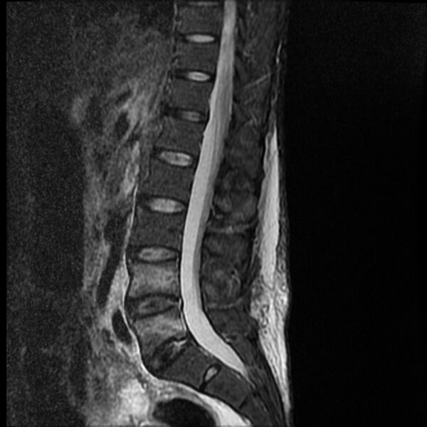File:Acute vertebral body compression fractures (Radiopaedia 31757-32694 Sagittal STIR 9).jpg