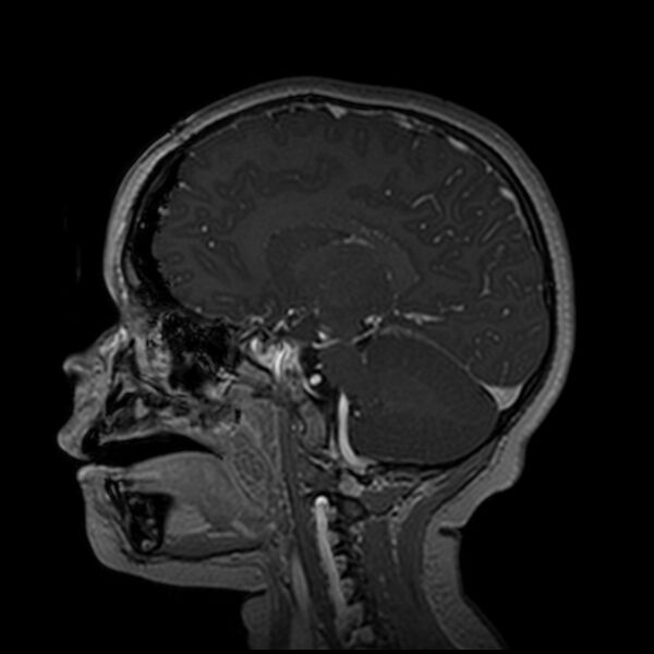 File:Adamantinomatous craniopharyngioma (Radiopaedia 77407-89529 H 52).jpg