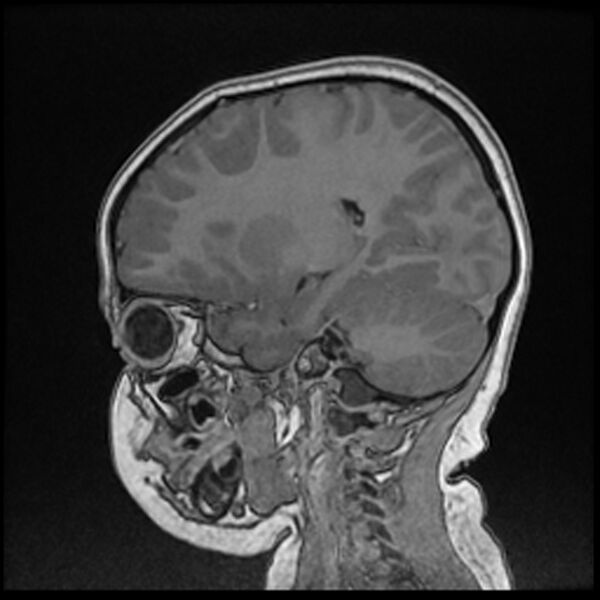 File:Adamantinomatous craniopharyngioma (Radiopaedia 77407-89529 Sagittal T1 C+ 88).jpg