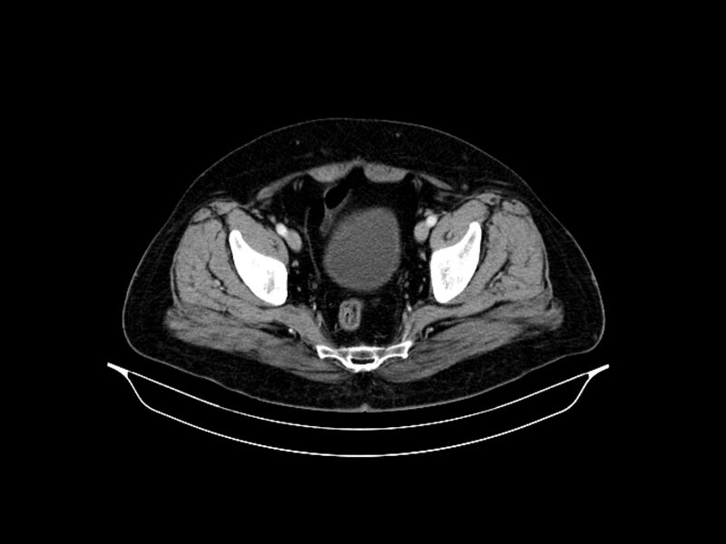 File:Adenocarcinoma of pancreas with hepatic metastasis (Radiopaedia 64332-73122 Axial C+ portal venous phase 89).jpg
