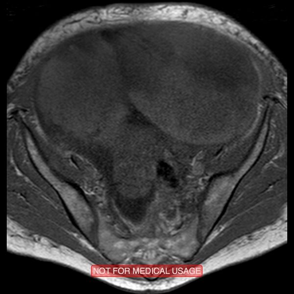 File:Adenocarcinoma of the cervix (Radiopaedia 28373-28615 Axial T1 18).jpg