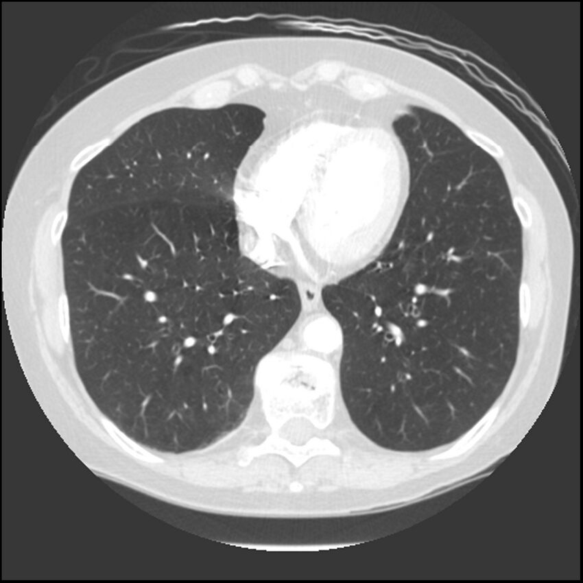 Adenocarcinoma of the lung (Radiopaedia 41015-43755 Axial lung window 86).jpg