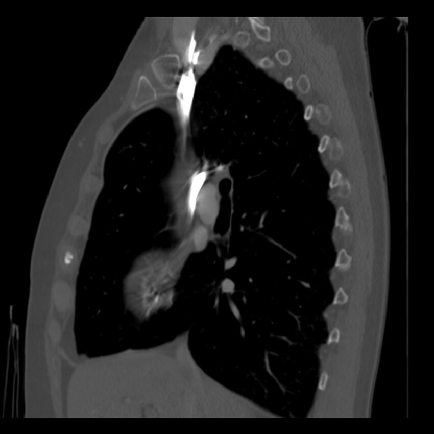 Adenocarcinoma of the lung (Radiopaedia 41015-43755 Sagittal bone window 42).jpg
