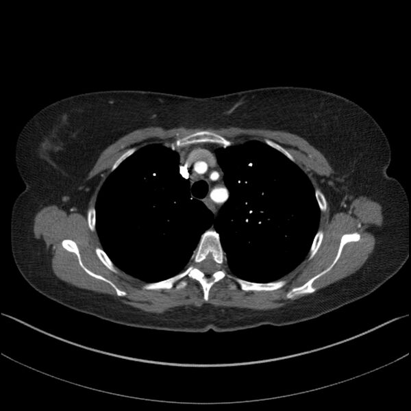 File:Adenocarcinoma of the lung (Radiopaedia 44205-47803 Axial C+ portal venous phase 21).jpg