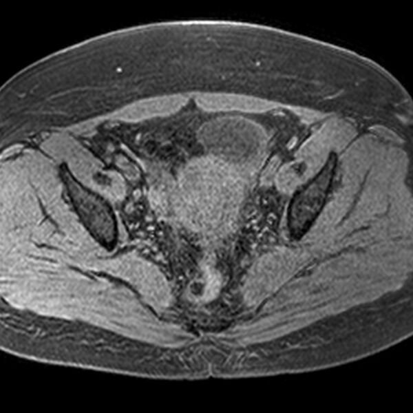 File:Adenomyoma of the uterus (Radiopaedia 9871-10439 Axial T1 fat sat 12).jpg