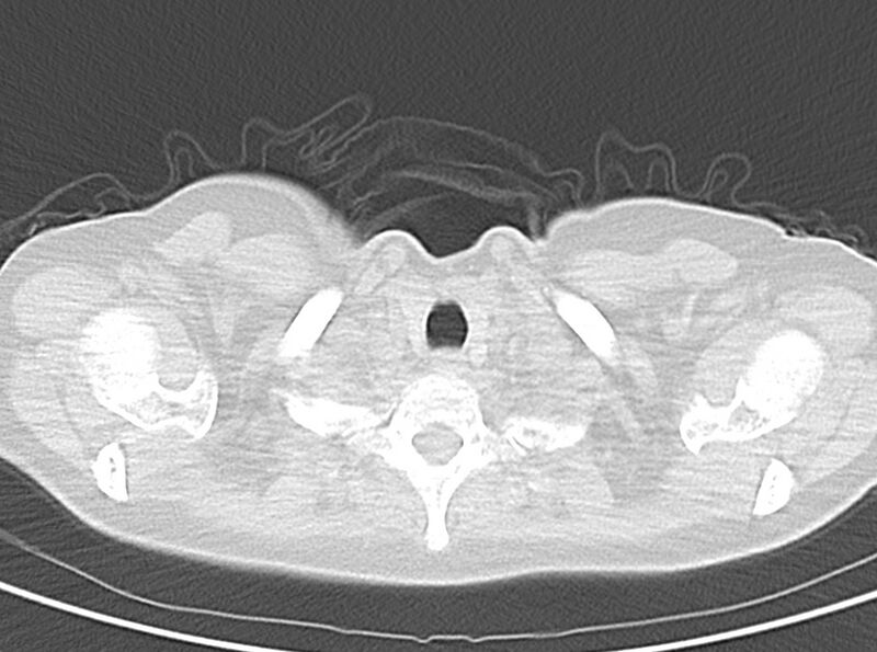 File:Adenosquamous lung carcinoma (Radiopaedia 22035-22030 lung window 11).jpg