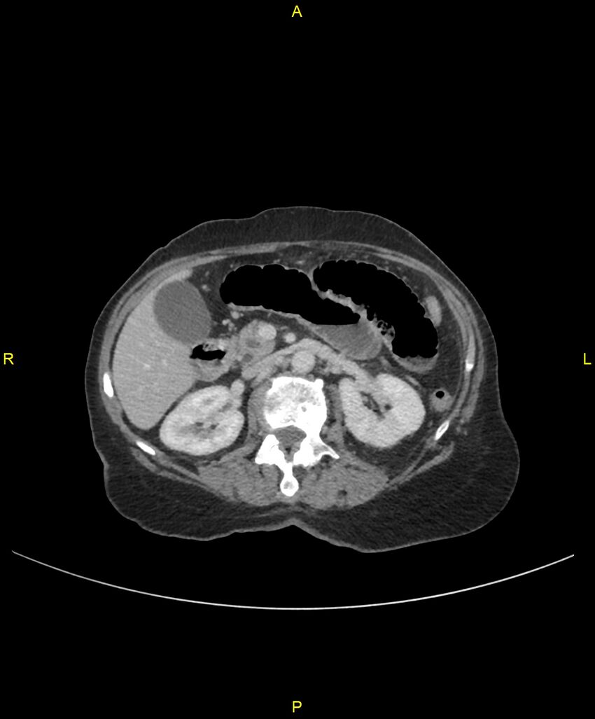 Adhesional small bowel obstruction (Radiopaedia 85402-101024 Axial C+ portal venous phase 106).jpg