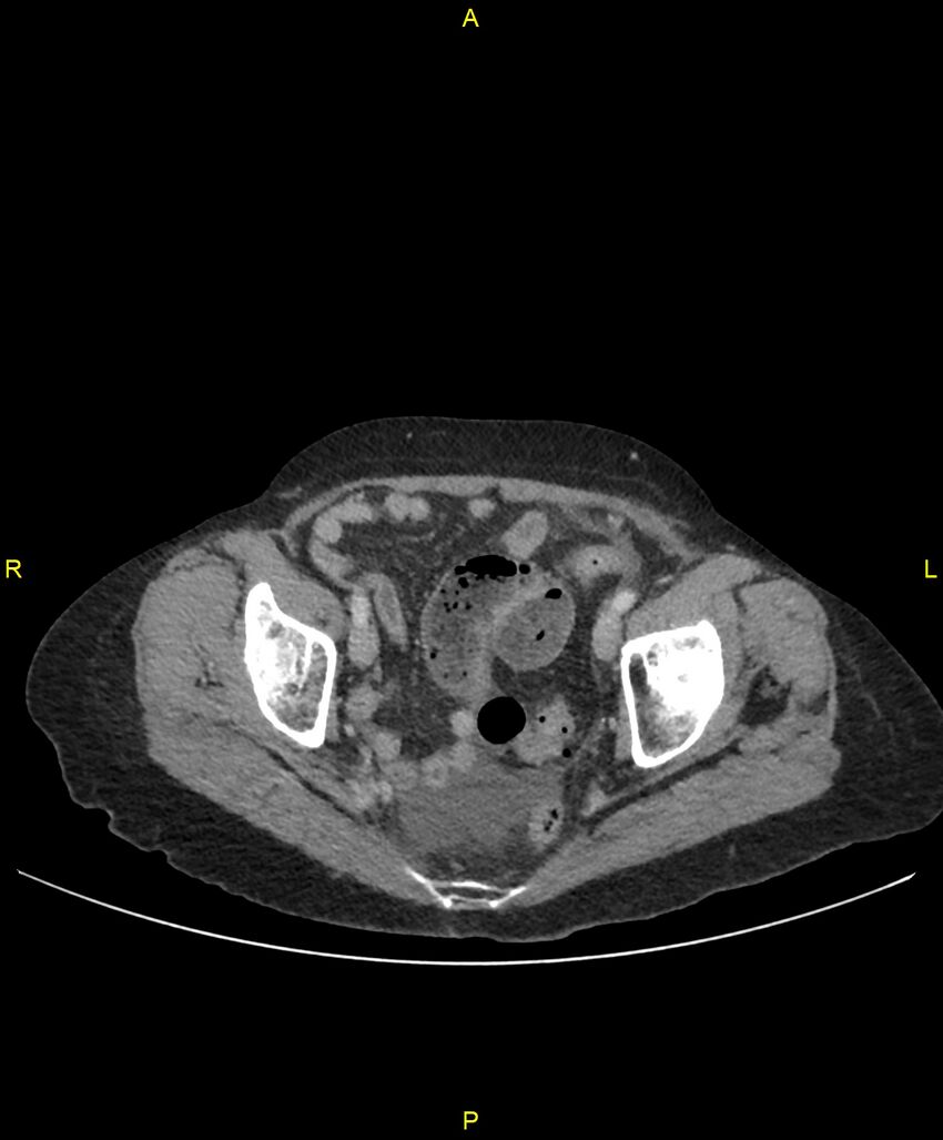 Adhesional small bowel obstruction (Radiopaedia 85402-101024 Axial C+ portal venous phase 250).jpg