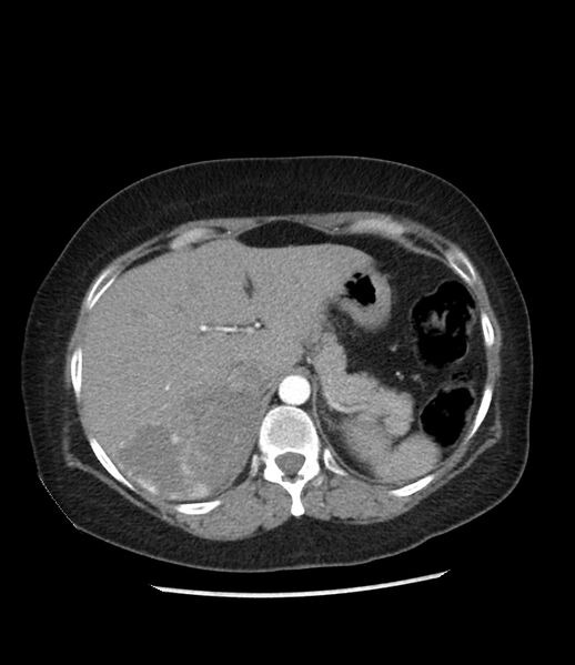 File:Adrenal cortical carcinoma with IVC invasion and thrombosis (Radiopaedia 34307-35597 Axial C+ arterial phase 21).jpg