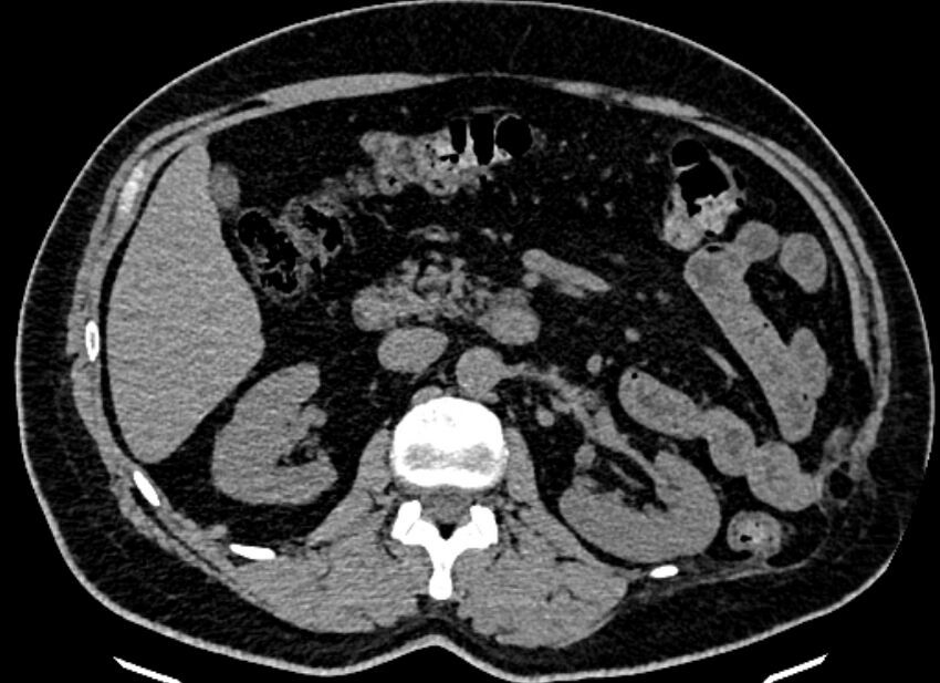 Adrenal metastases (Radiopaedia 73082-83791 Axial non-contrast 76).jpg