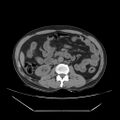 Adrenal myelolipoma (Radiopaedia 41843-44834 Axial non-contrast 37).jpg