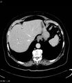 Adrenal myelolipoma (Radiopaedia 6765-7960 Axial C+ arterial phase 3).jpg