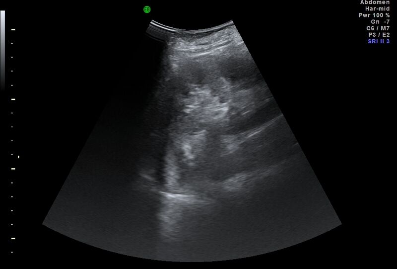 File:Adrenal myelolipoma - bilateral (Radiopaedia 74805-85811 Abdominal ultrasound 16).jpg