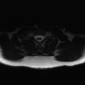Aggressive vertebral hemangioma (Radiopaedia 39937-42404 Axial T2 42).png