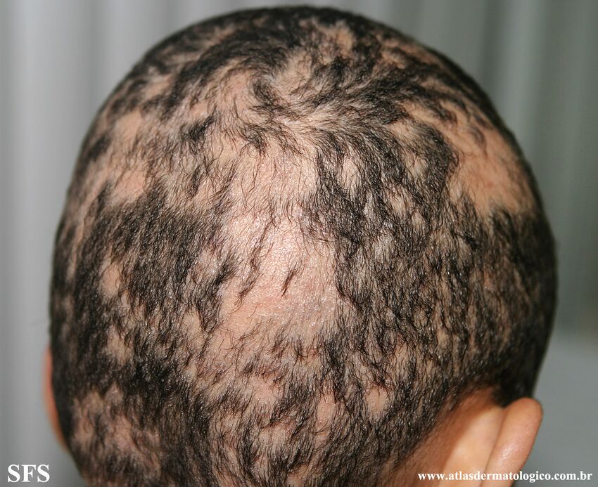 Alopecia Areata (Dermatology Atlas 66).jpg