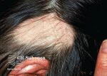 Alopecia areata (DermNet NZ hair-nails-sweat-alopecia-areata-1322).jpg