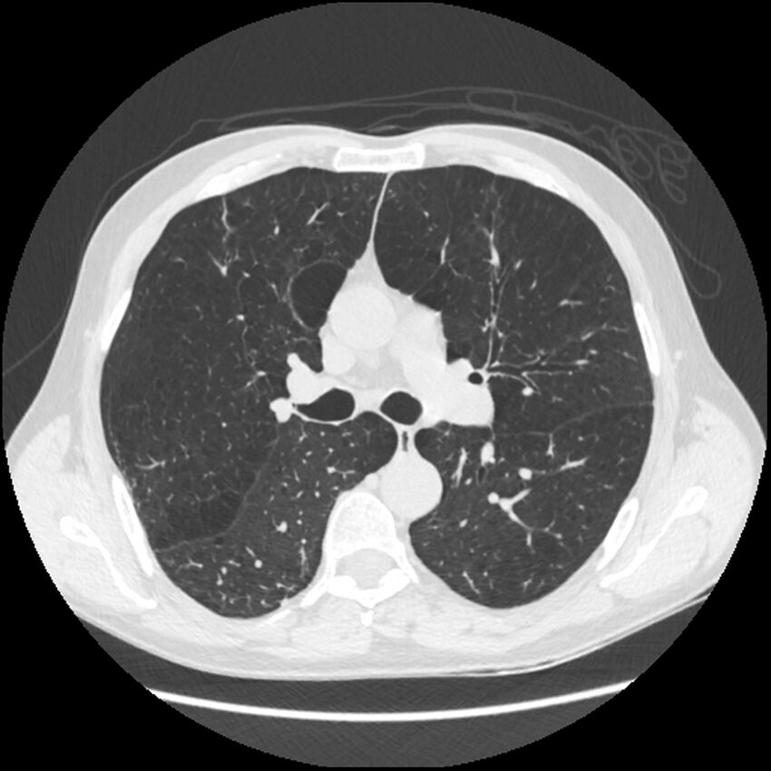 Alpha-1-antitrypsin deficiency (Radiopaedia 40993-43722 Axial lung window 100).jpg