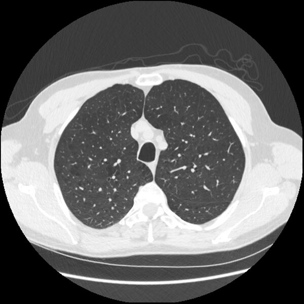 File:Alpha-1-antitrypsin deficiency (Radiopaedia 40993-43722 Axial lung window 50).jpg