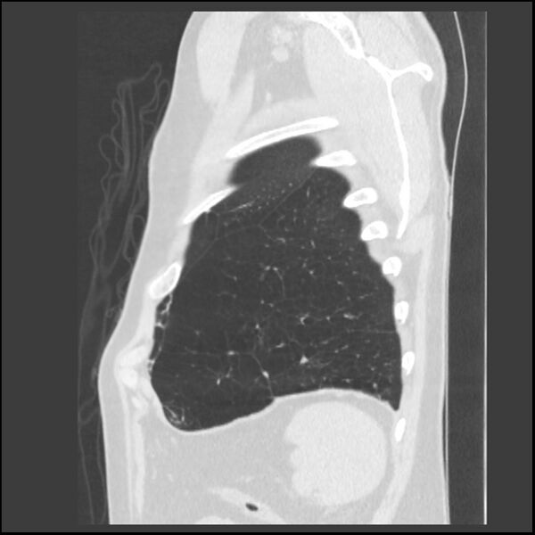 File:Alpha-1-antitrypsin deficiency (Radiopaedia 40993-43722 Sagittal lung window 34).jpg