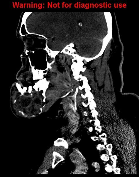 File:Ameloblastoma (Radiopaedia 33126-34164 F 45).jpg