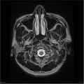 Amnestic syndrome secondary to hypoxic brain injury (Radiopaedia 24743-25004 T2 1).jpg