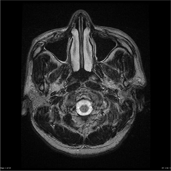 File:Amnestic syndrome secondary to hypoxic brain injury (Radiopaedia 24743-25004 T2 1).jpg