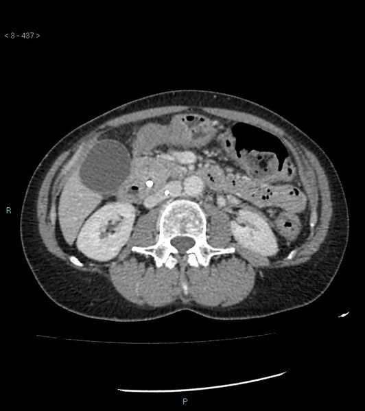 File:Ampulla of Vater metastasis (Radiopaedia 27820-28069 A 75).jpg