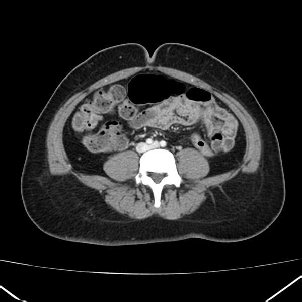 File:Ampullary tumor (Radiopaedia 22787-22816 C 41).jpg